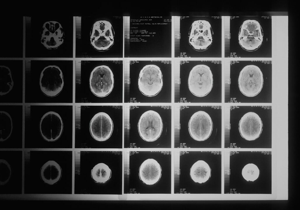 Brain injury lawyer